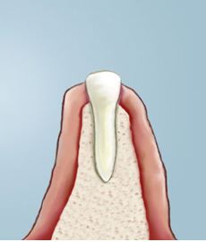 Crown lengthening example