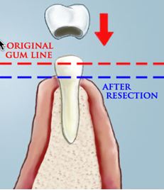 Crown lengthening example