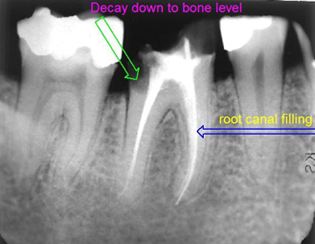 Crown lengthening example