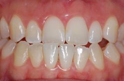 Crown lengthening example