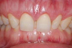 Crown lengthening example