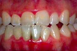 Crown lengthening example