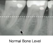 Healthy bone level example