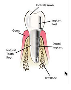 Implant diagram