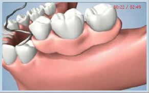 dental implant illustration