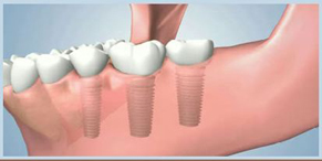 dental implant illustration