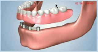 Dental implant illustration