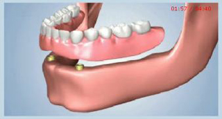 Dental implant illustration