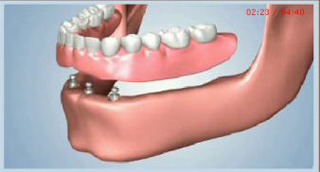 Dental implant illustration