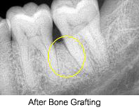 Bone grafting example