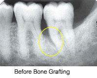 Bone grafting example