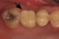 Dental implant cases