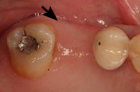 Dental implant cases