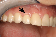 Single implant crown