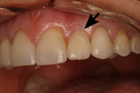 Single implant crown