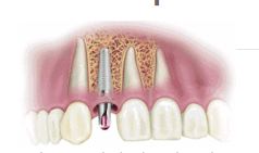 Implant diagram