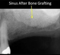 Sinus graft example