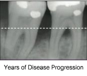 Unhealthy bone level example