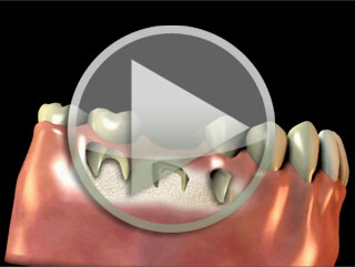 Socket Preservation Techniques El Paso TX